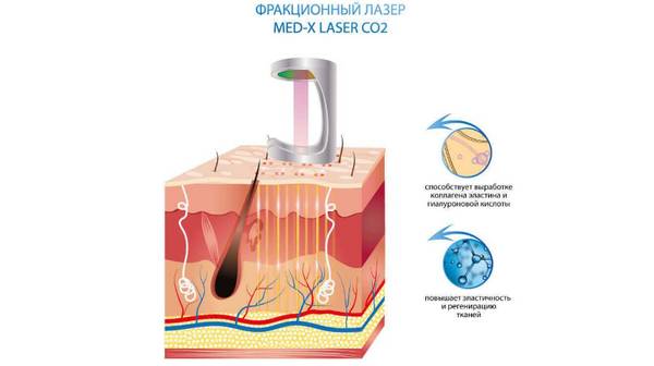 Фракционные лазеры CO2: назначение и преимущества