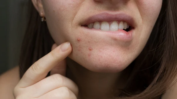 Врач назвала 3 продукта, которые провоцируют акне