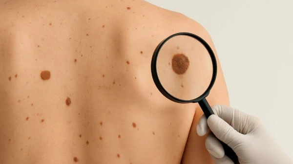 Эти приметы о родинках вы точно раньше не знали: что делать категориче...