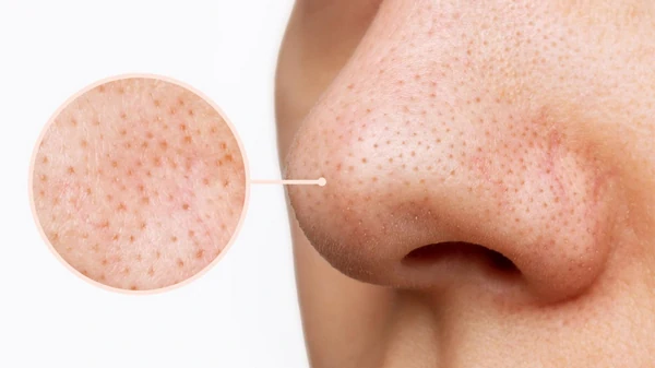 Закупоренные поры: что на самом деле происходит с кожей и как это испр...