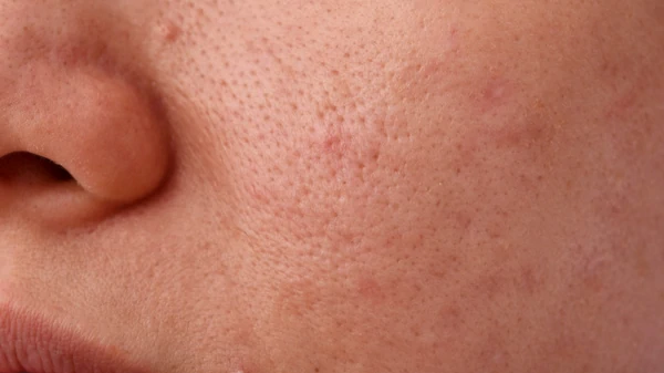 Почему поры перестают очищаться самостоятельно