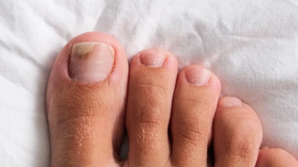 Как избавиться от грибка ногтей на ногах: 7 домашних средств