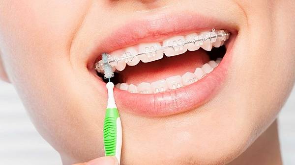 Як доглядати за зубами під час носіння брекетів