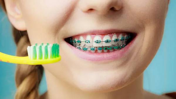 Як доглядати за зубами під час носіння брекетів