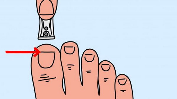 К чему приводит неправильная стрижка ногтей и как избежать проблем со здоровьем