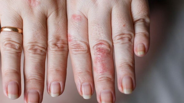 Сыпь на руках бразильянки оказалась симптомом рака легких